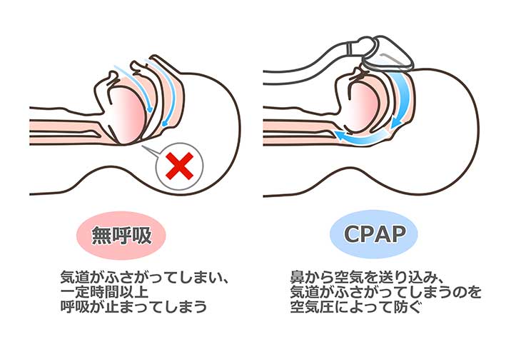 無呼吸を防ぐ